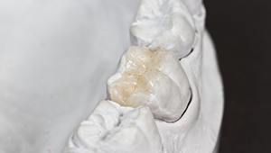 Dental model with inlay restoration