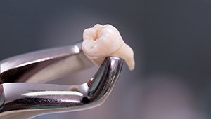 Metal clasps holding extracted tooth
